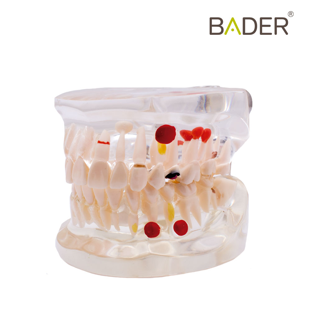 MODÈLE DENTAIRE TRANSPARENT CARIES